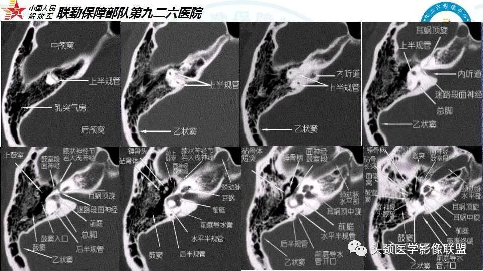 影像PPT - 【PPT】耳硬化症的临床、病理及HRCT表现-42 影像PPT - 【PPT】耳硬化症的临床、病理及HRCT表现-42