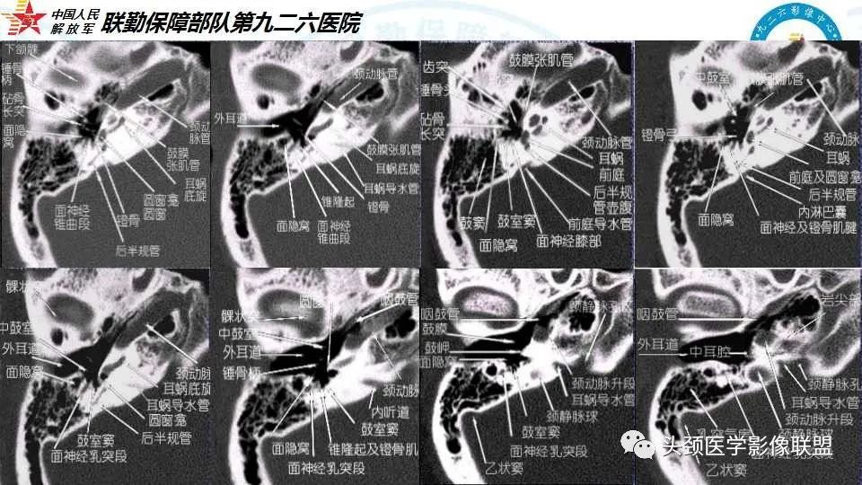 影像PPT - 【PPT】耳硬化症的临床、病理及HRCT表现-43 影像PPT - 【PPT】耳硬化症的临床、病理及HRCT表现-43