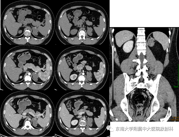 影像PPT - 【PPT】肾上腺神经源性肿瘤-1