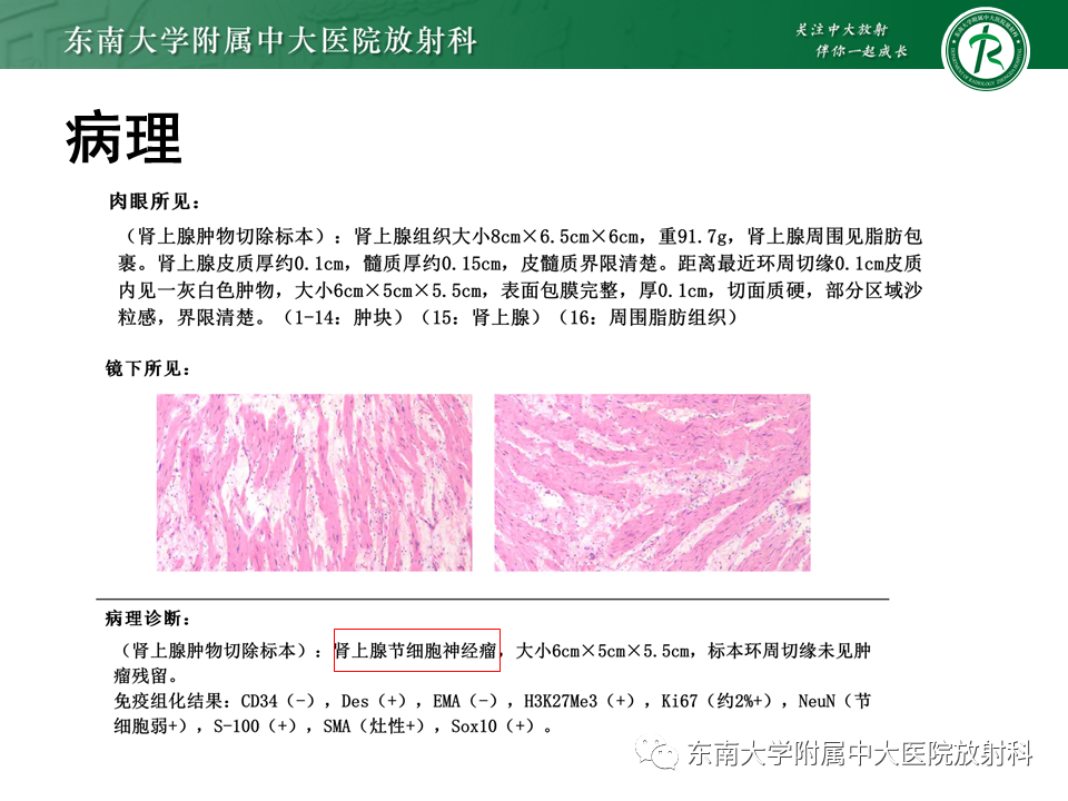 影像PPT - 【PPT】肾上腺神经源性肿瘤-3