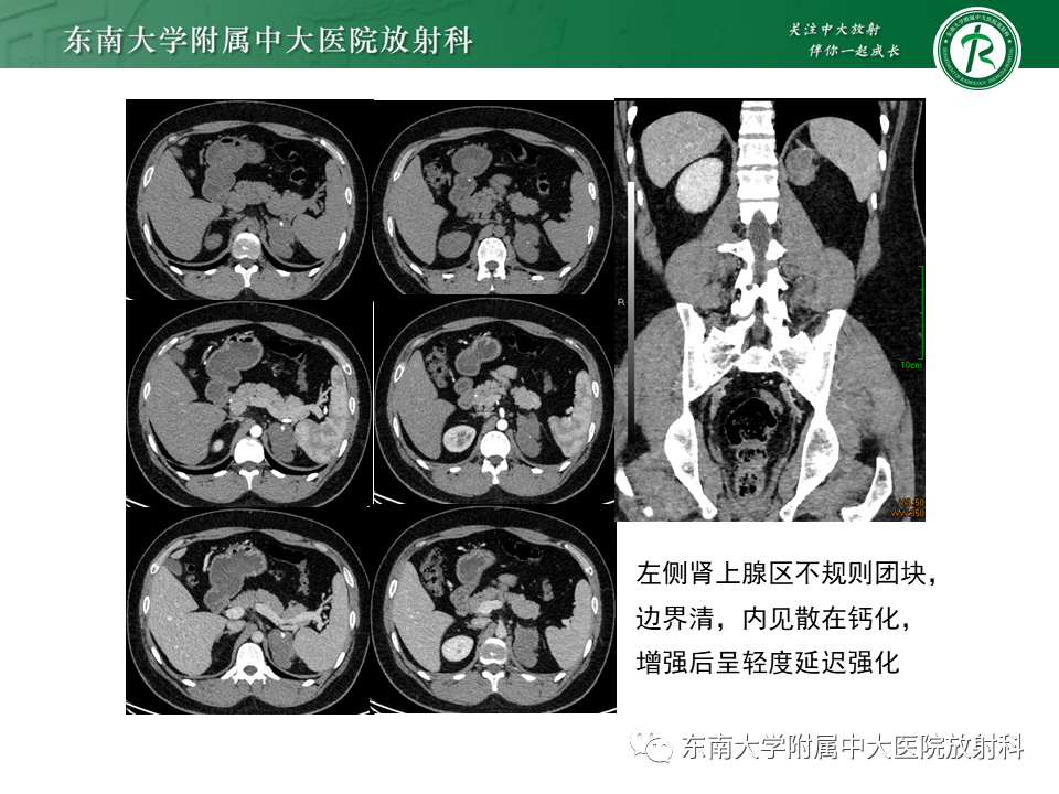 影像PPT - 【PPT】肾上腺神经源性肿瘤-2
