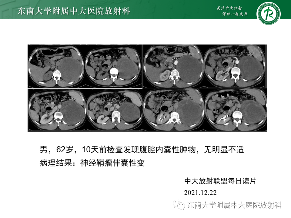 影像PPT - 【PPT】肾上腺神经源性肿瘤-20