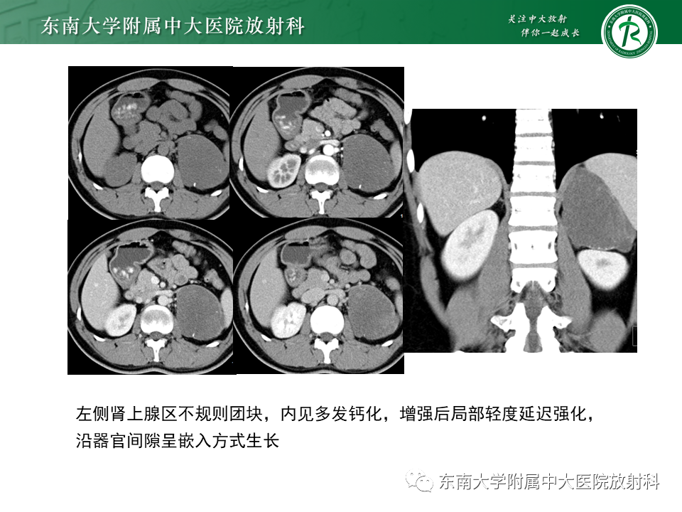 影像PPT - 【PPT】肾上腺神经源性肿瘤-14