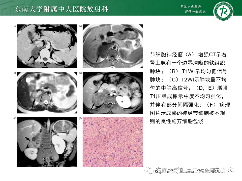影像PPT - 【PPT】肾上腺神经源性肿瘤-16