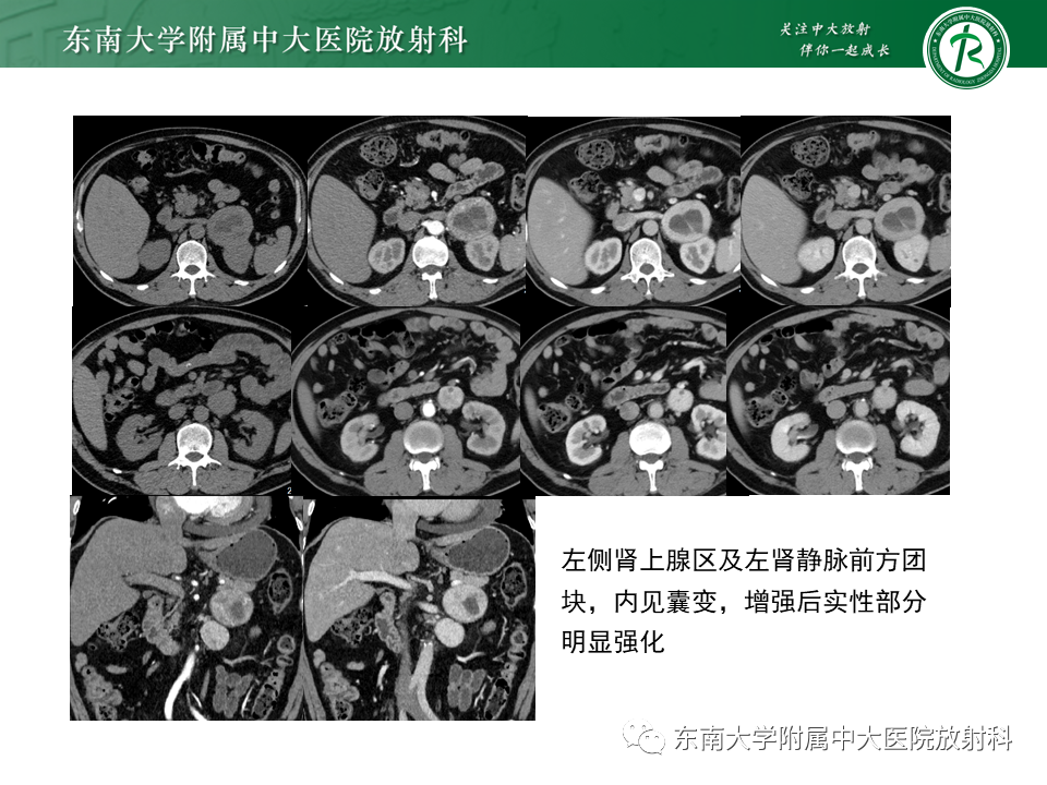 影像PPT - 【PPT】肾上腺神经源性肿瘤-24