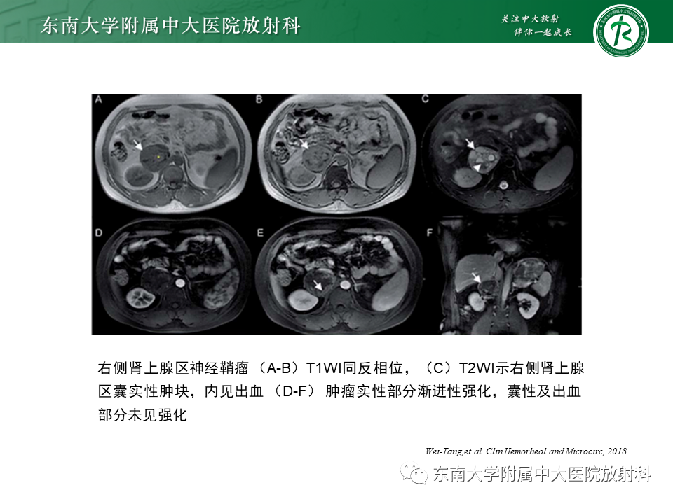 影像PPT - 【PPT】肾上腺神经源性肿瘤-22