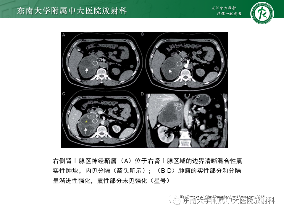 影像PPT - 【PPT】肾上腺神经源性肿瘤-21