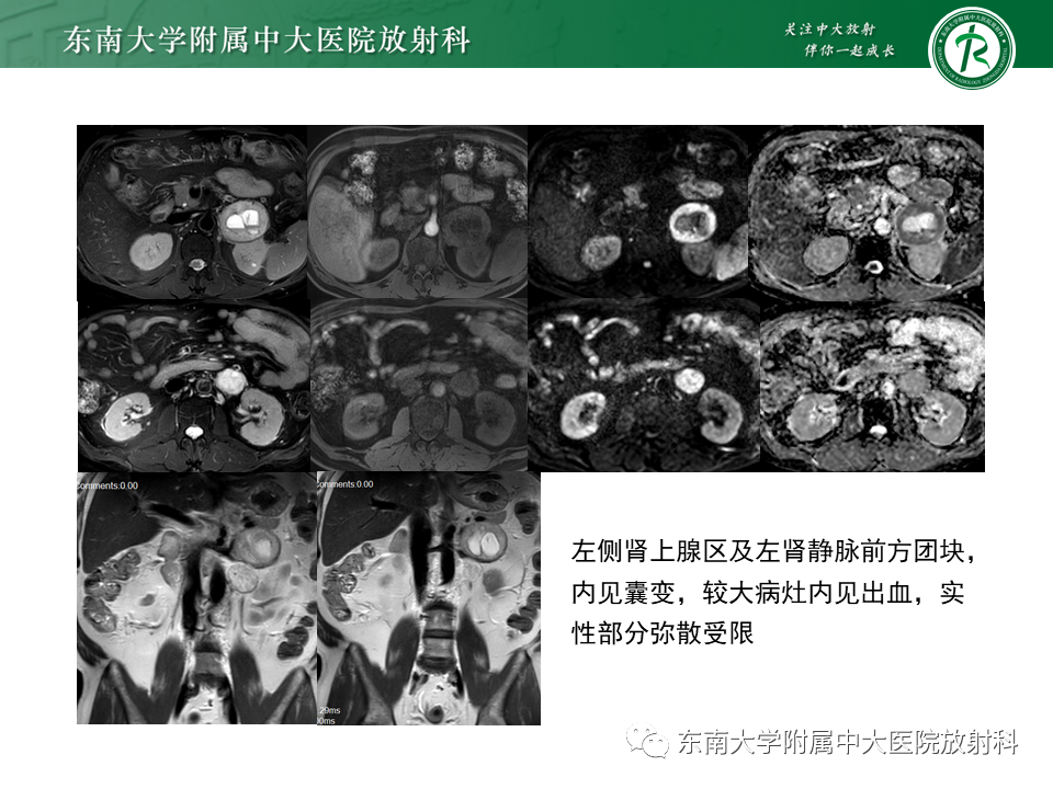 影像PPT - 【PPT】肾上腺神经源性肿瘤-25
