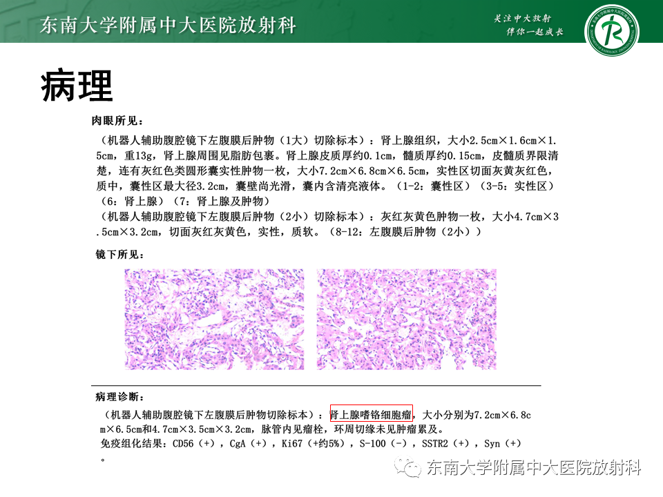 影像PPT - 【PPT】肾上腺神经源性肿瘤-26