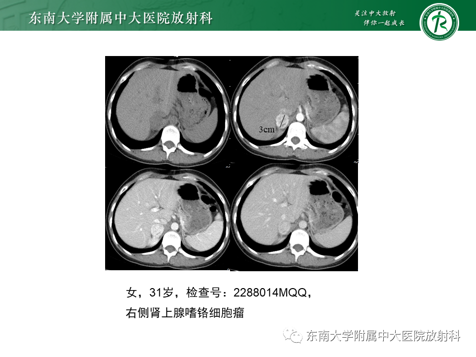 影像PPT - 【PPT】肾上腺神经源性肿瘤-31