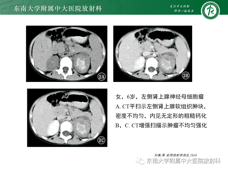 影像PPT - 【PPT】肾上腺神经源性肿瘤-37