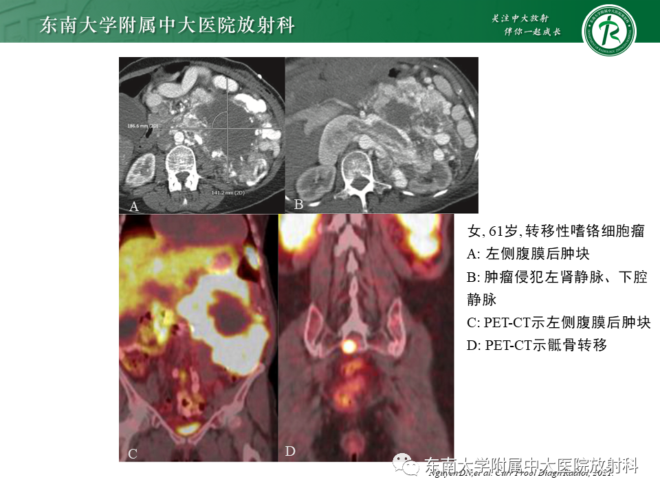 影像PPT - 【PPT】肾上腺神经源性肿瘤-32