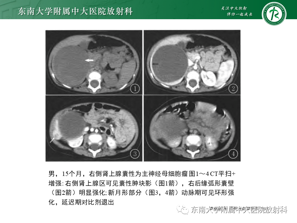 影像PPT - 【PPT】肾上腺神经源性肿瘤-38