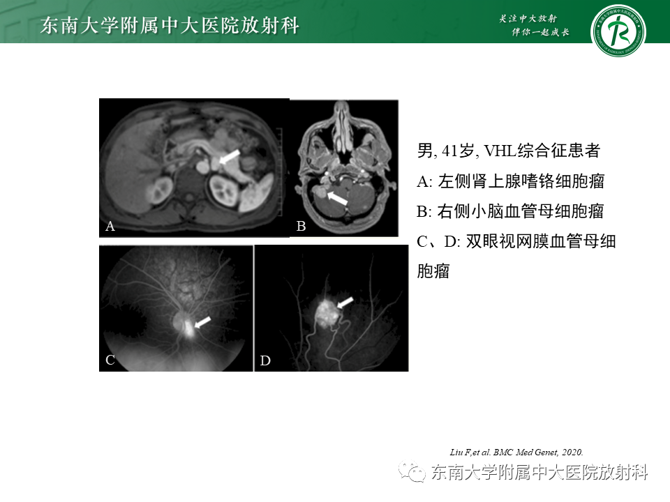 影像PPT - 【PPT】肾上腺神经源性肿瘤-33