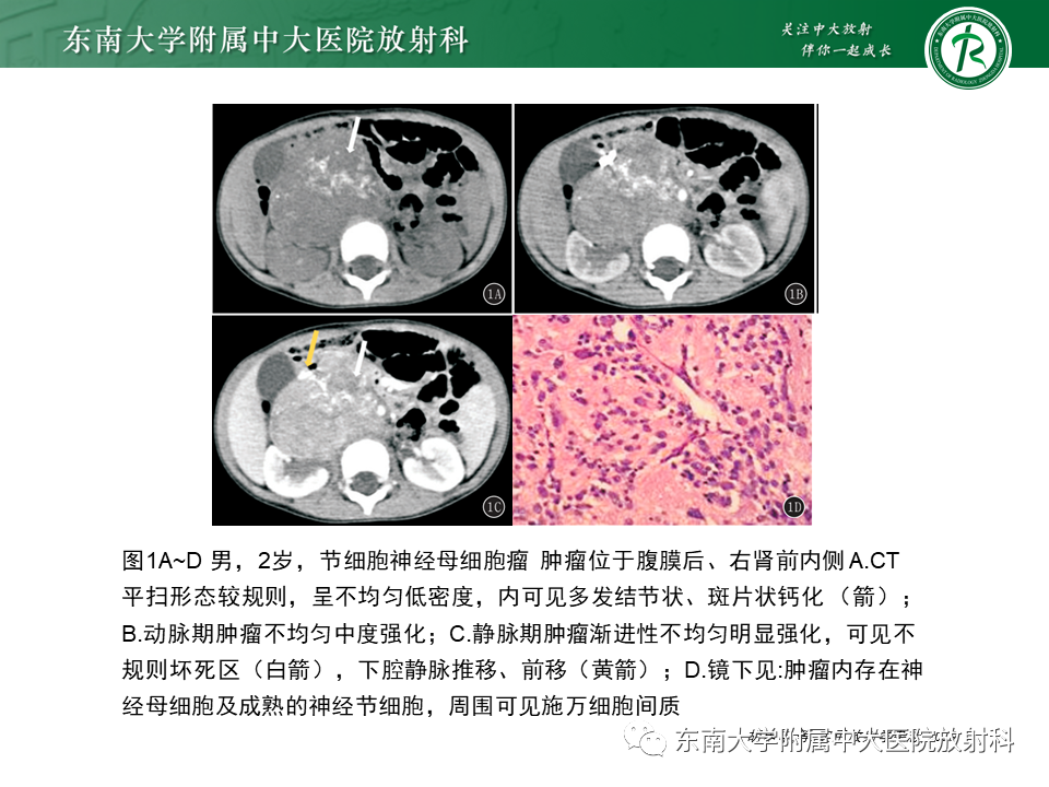 影像PPT - 【PPT】肾上腺神经源性肿瘤-41