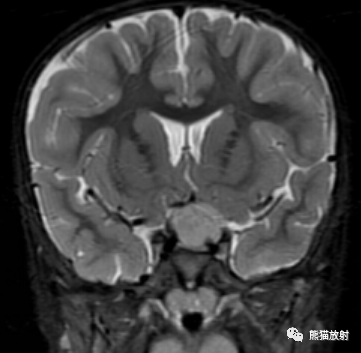 影像PPT - 【病例】视神经胶质瘤1例MR影像表现及鉴别-3 影像PPT - 【病例】视神经胶质瘤1例MR影像表现及鉴别-3