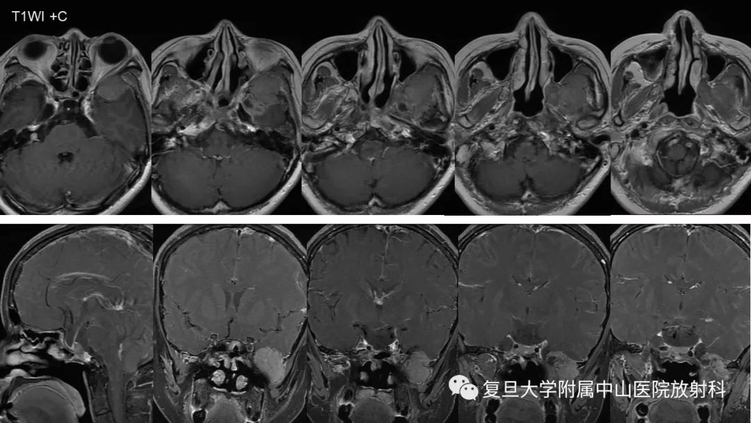 影像PPT - 【病例】垂体癌1例CT及MR影像-4