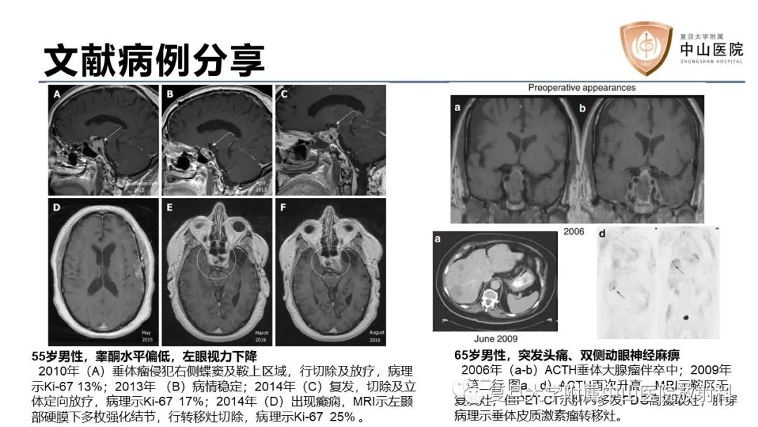 影像PPT - 【病例】垂体癌1例CT及MR影像-13