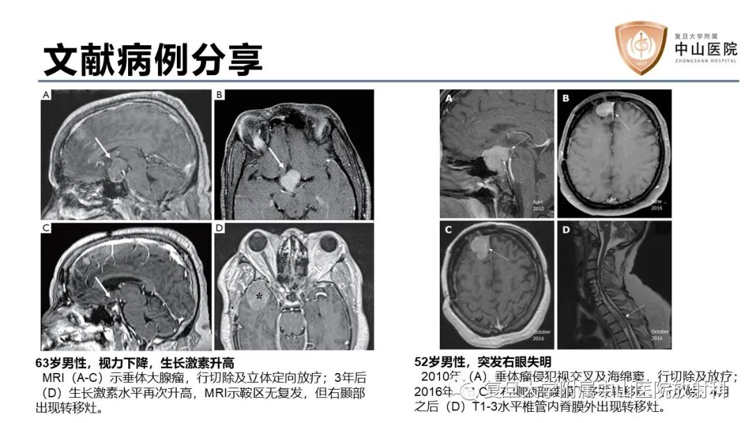 影像PPT - 【病例】垂体癌1例CT及MR影像-12