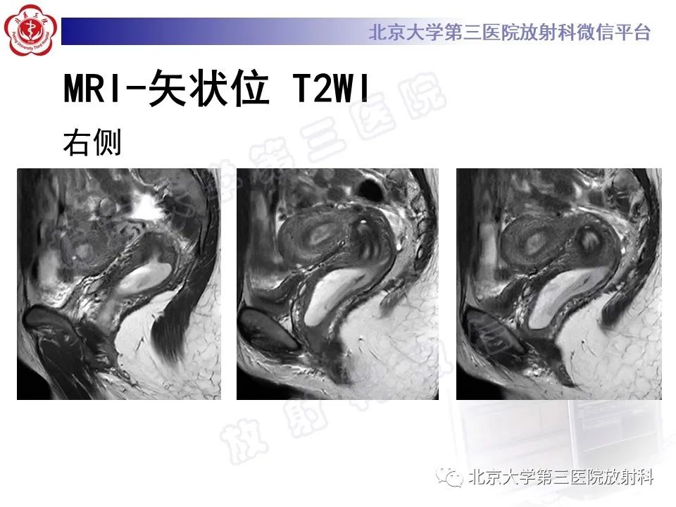影像PPT - 【PPT】阴道斜隔综合征-4