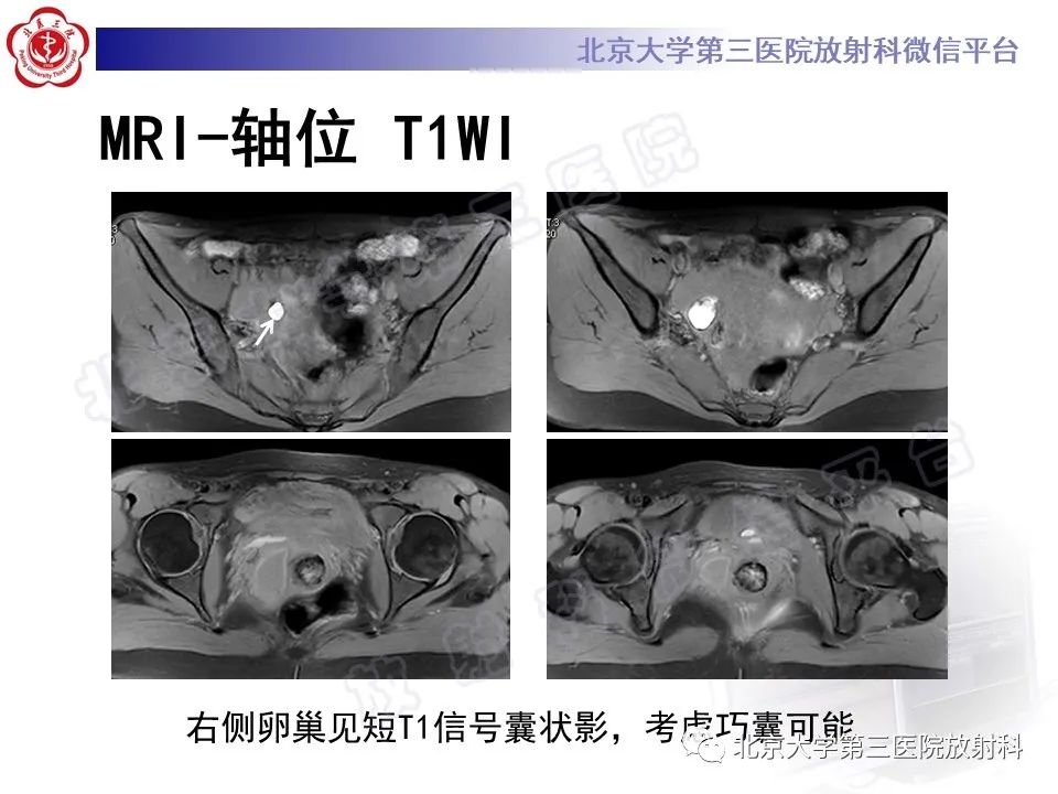 影像PPT - 【PPT】阴道斜隔综合征-7