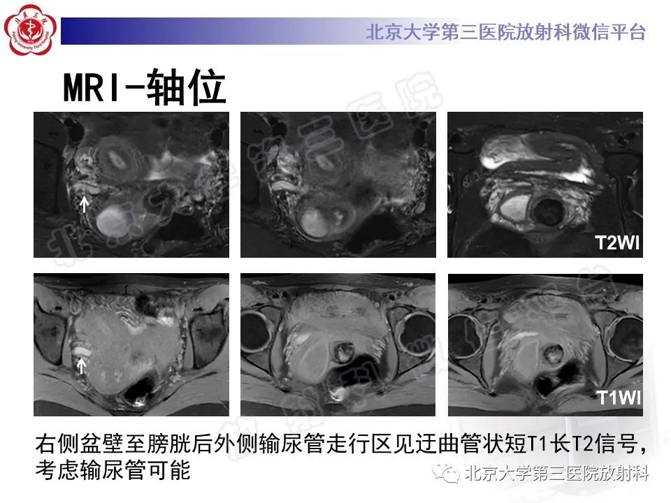 影像PPT - 【PPT】阴道斜隔综合征-8