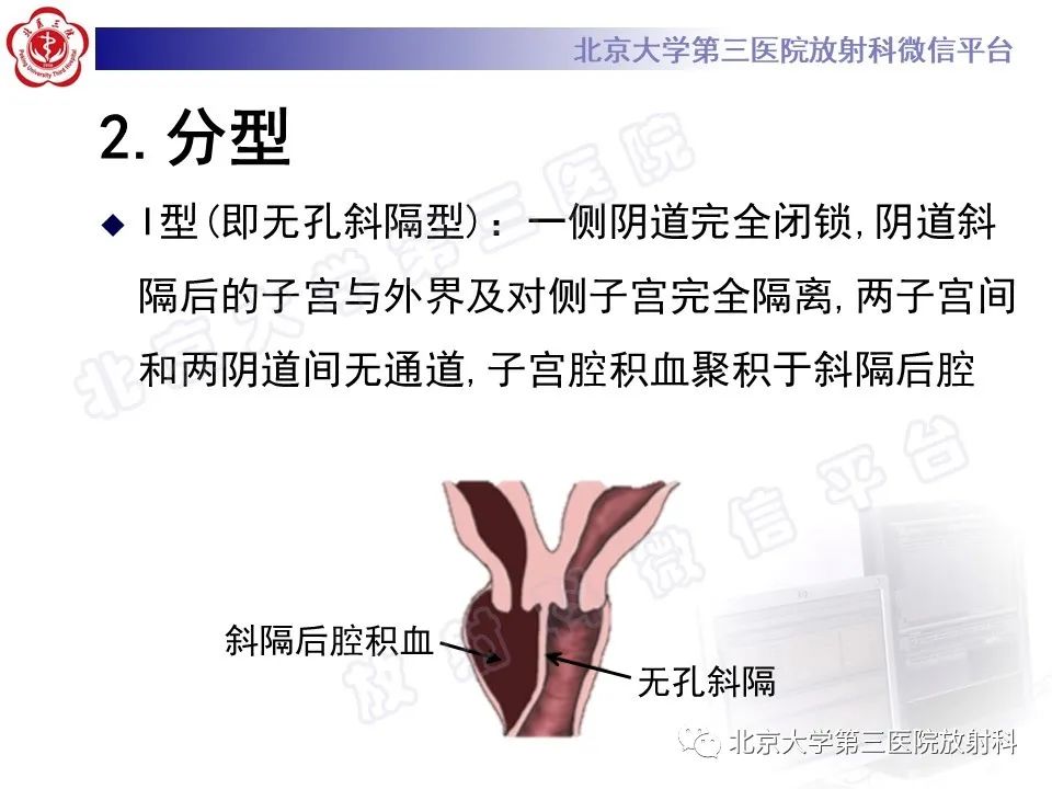 影像PPT - 【PPT】阴道斜隔综合征-18