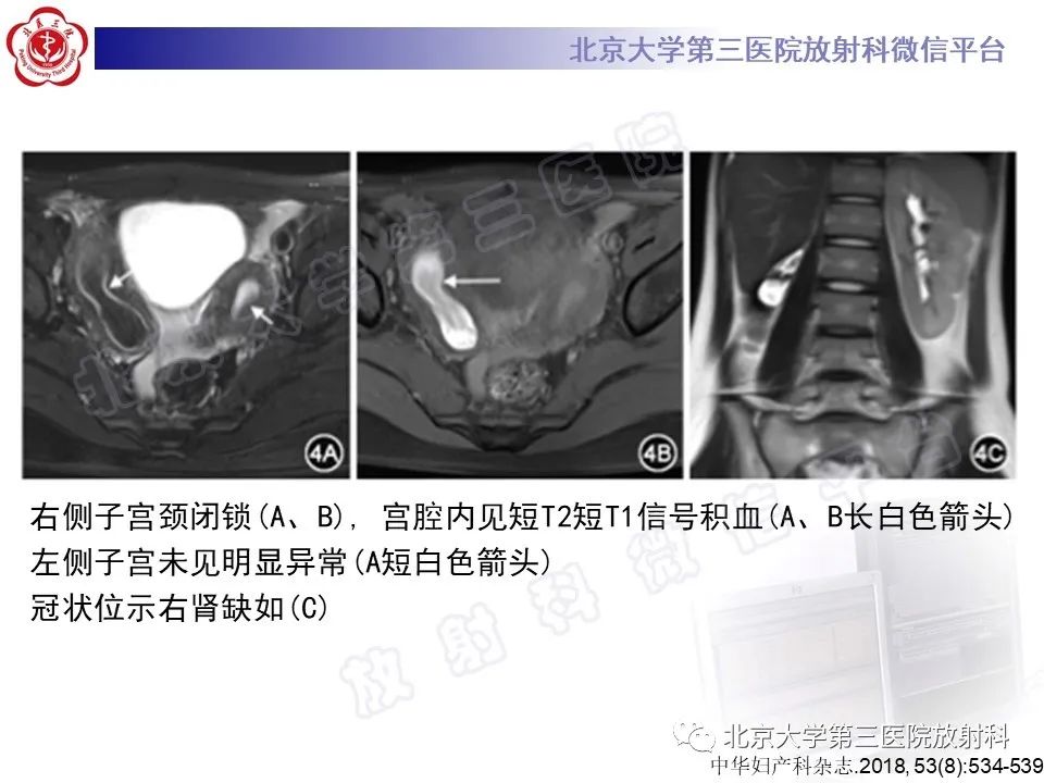 影像PPT - 【PPT】阴道斜隔综合征-23