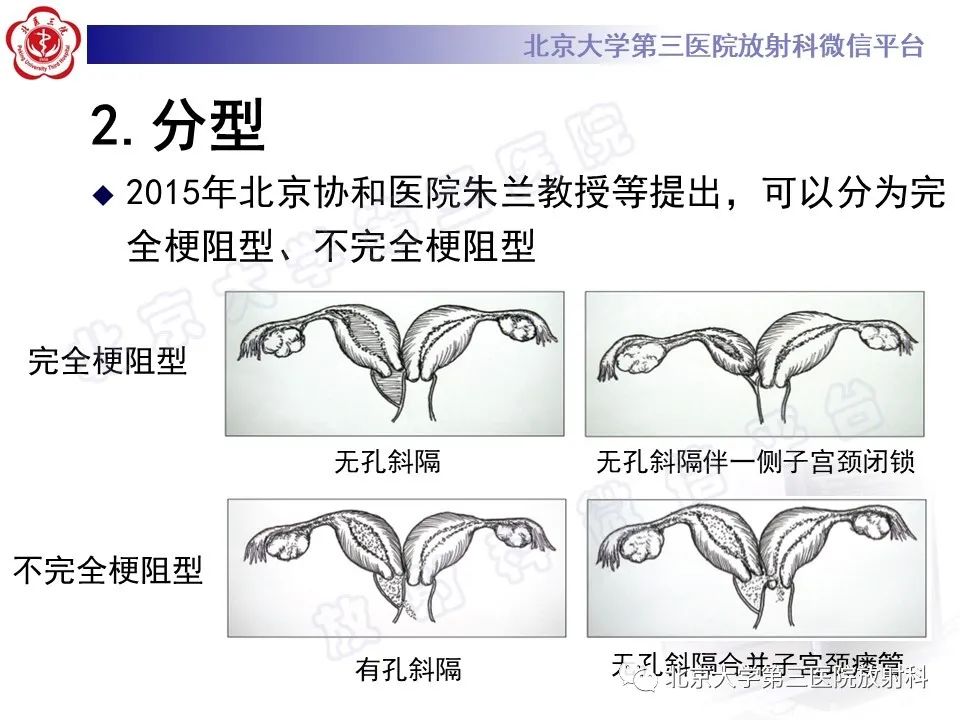 影像PPT - 【PPT】阴道斜隔综合征-24