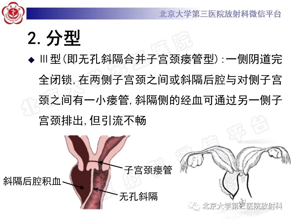 影像PPT - 【PPT】阴道斜隔综合征-20