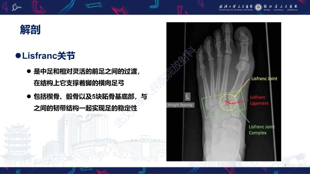 影像PPT - 【PPT】Lisfranc关节损伤影像诊断-7