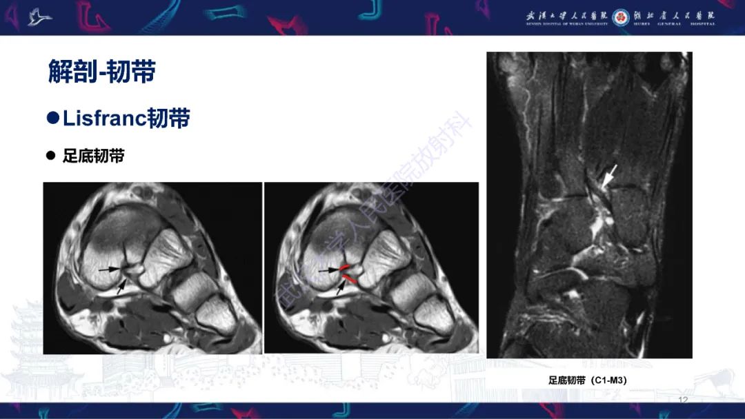 影像PPT - 【PPT】Lisfranc关节损伤影像诊断-12