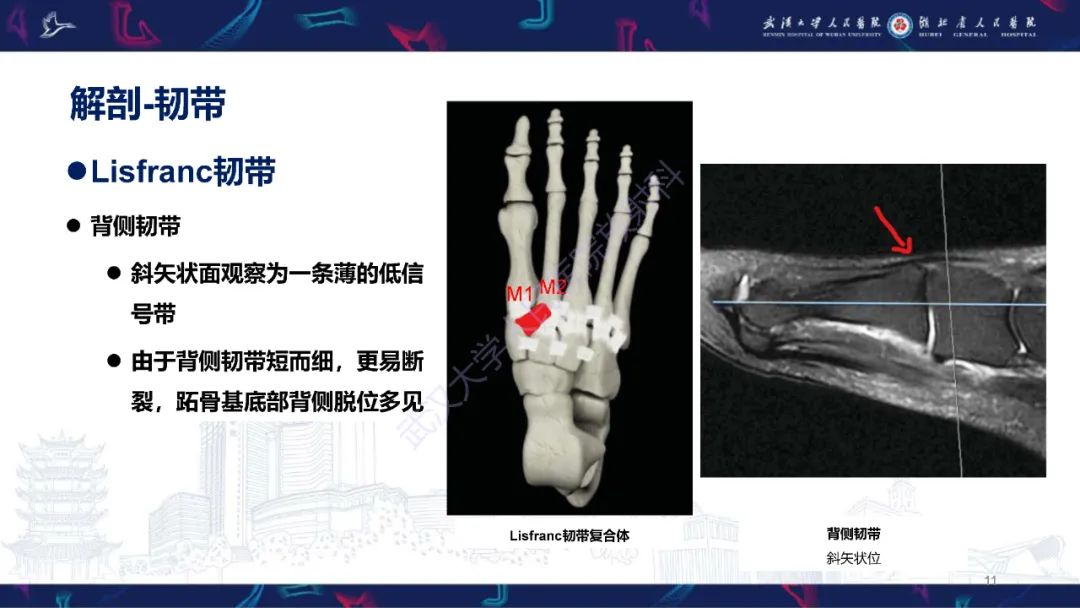 影像PPT - 【PPT】Lisfranc关节损伤影像诊断-11
