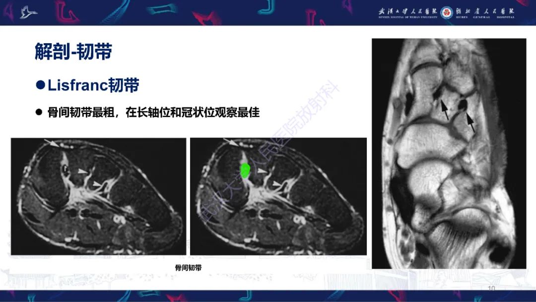 影像PPT - 【PPT】Lisfranc关节损伤影像诊断-10