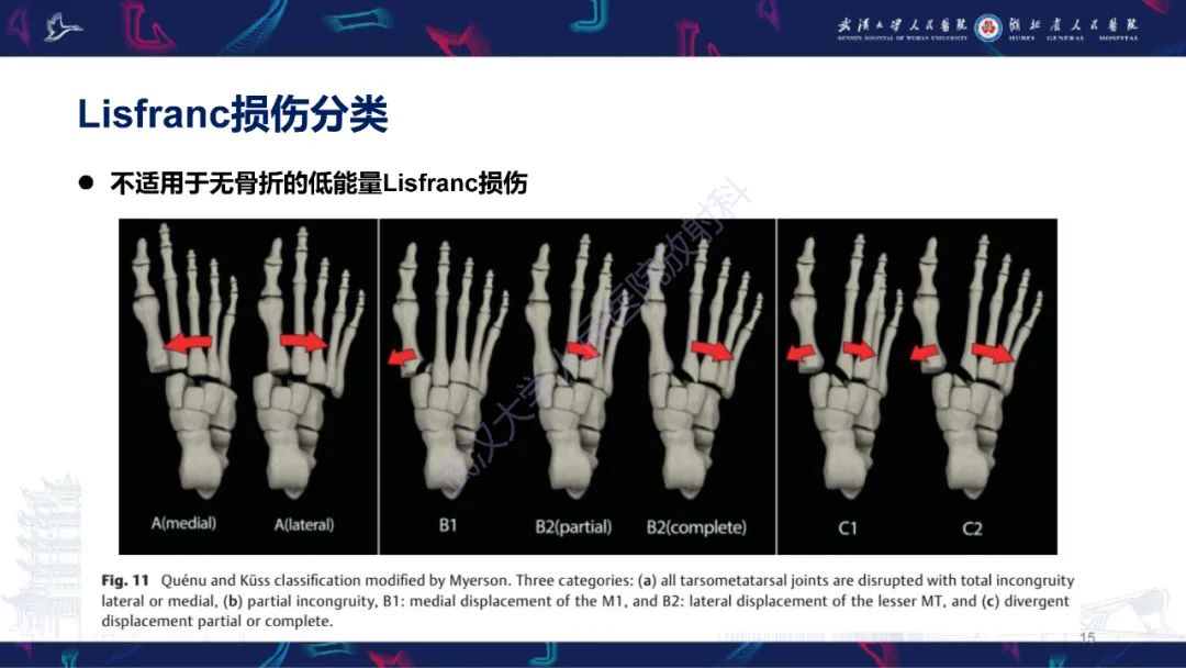影像PPT - 【PPT】Lisfranc关节损伤影像诊断-15