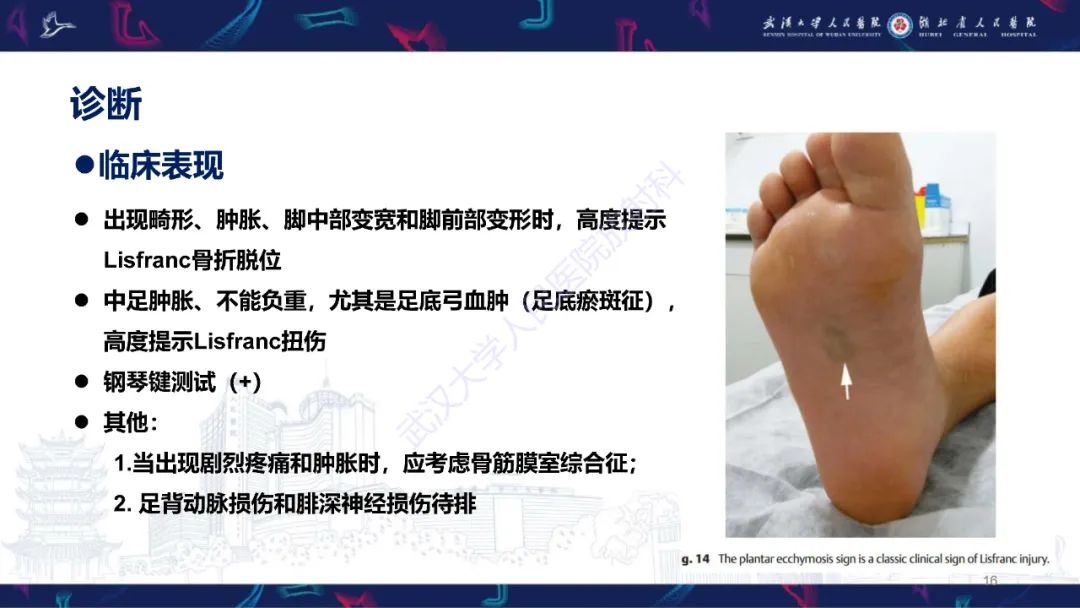 影像PPT - 【PPT】Lisfranc关节损伤影像诊断-16