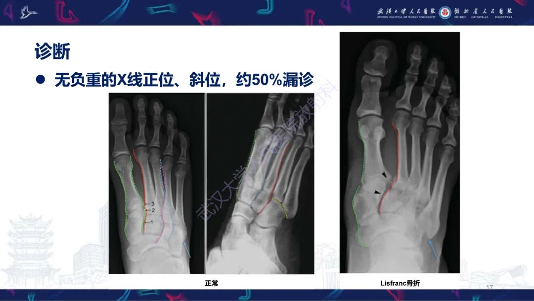 影像PPT - 【PPT】Lisfranc关节损伤影像诊断-17