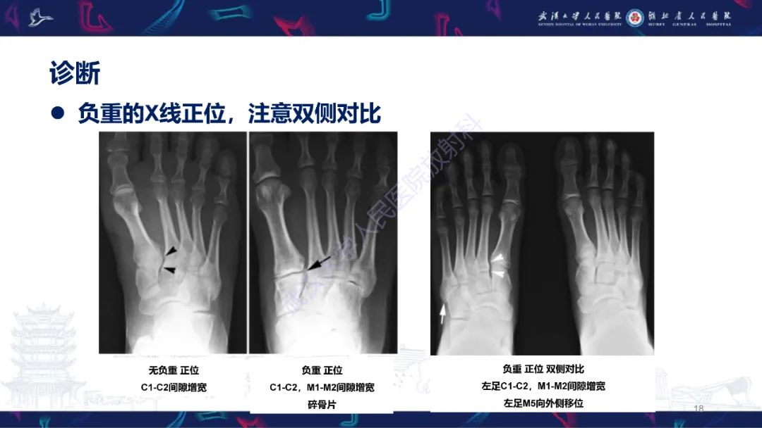 影像PPT - 【PPT】Lisfranc关节损伤影像诊断-18