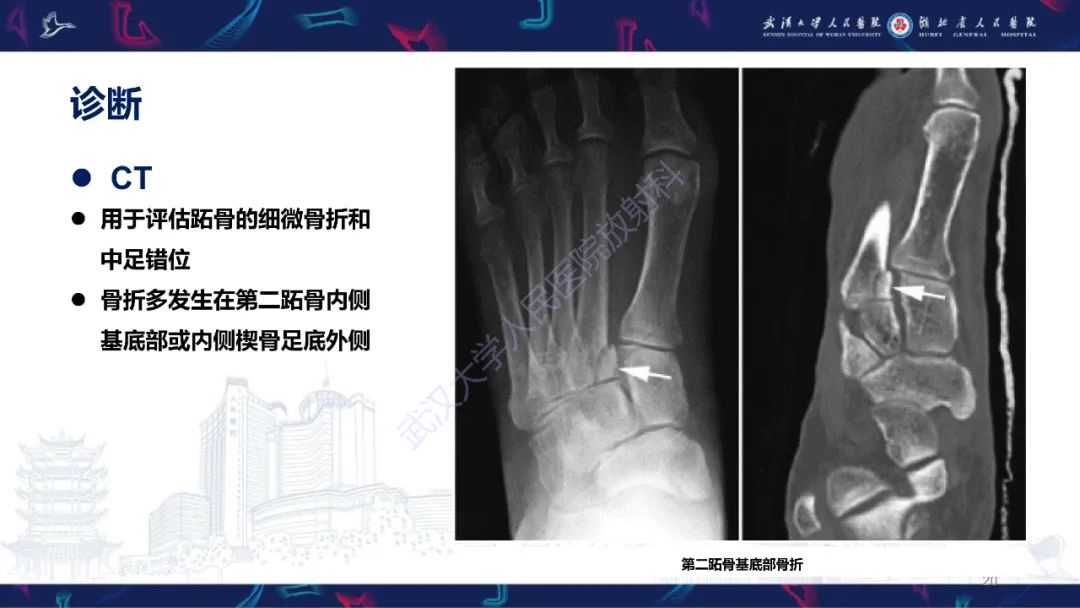 影像PPT - 【PPT】Lisfranc关节损伤影像诊断-20