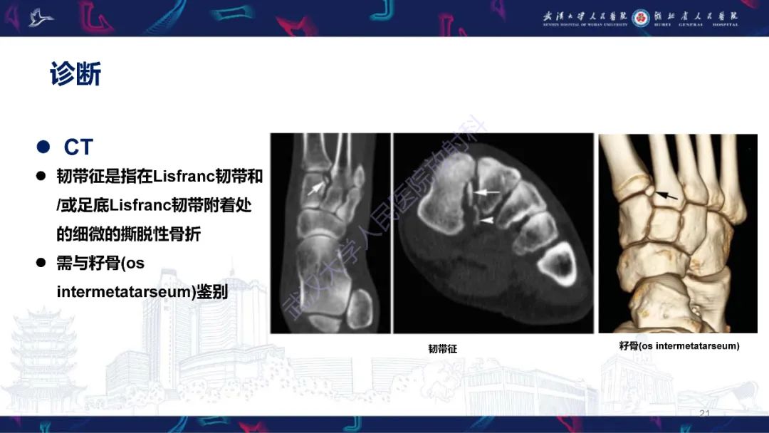 影像PPT - 【PPT】Lisfranc关节损伤影像诊断-21