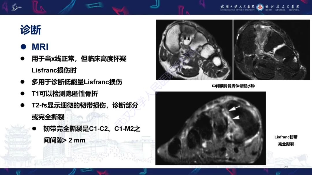 影像PPT - 【PPT】Lisfranc关节损伤影像诊断-23
