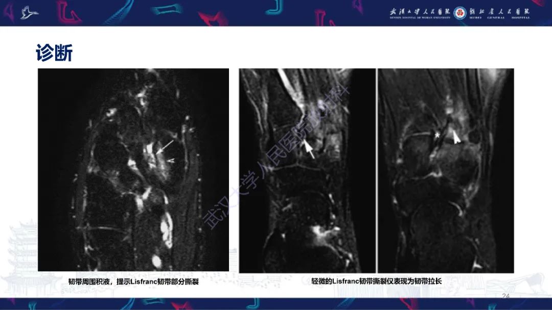 影像PPT - 【PPT】Lisfranc关节损伤影像诊断-24