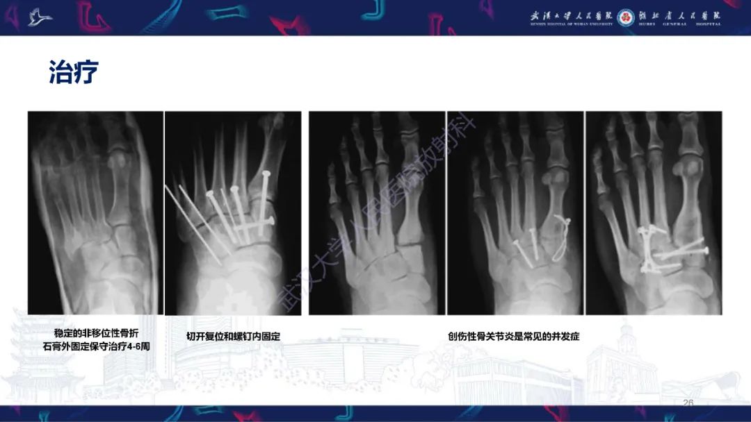 影像PPT - 【PPT】Lisfranc关节损伤影像诊断-26