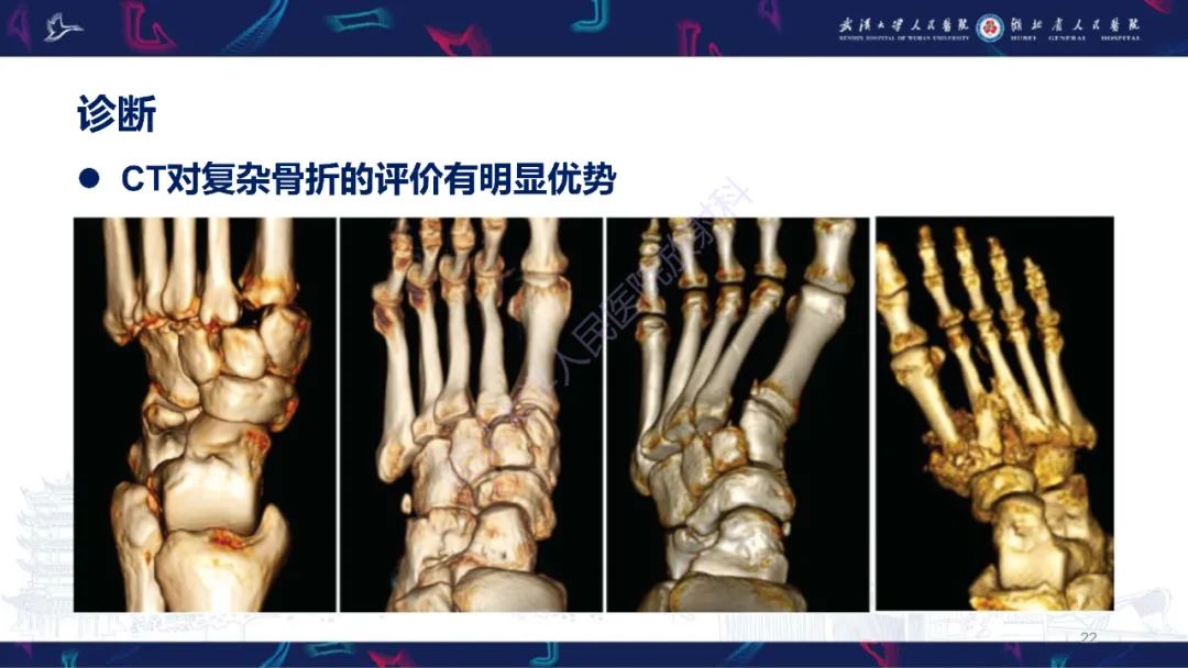 影像PPT - 【PPT】Lisfranc关节损伤影像诊断-22