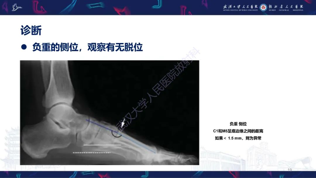 影像PPT - 【PPT】Lisfranc关节损伤影像诊断-19