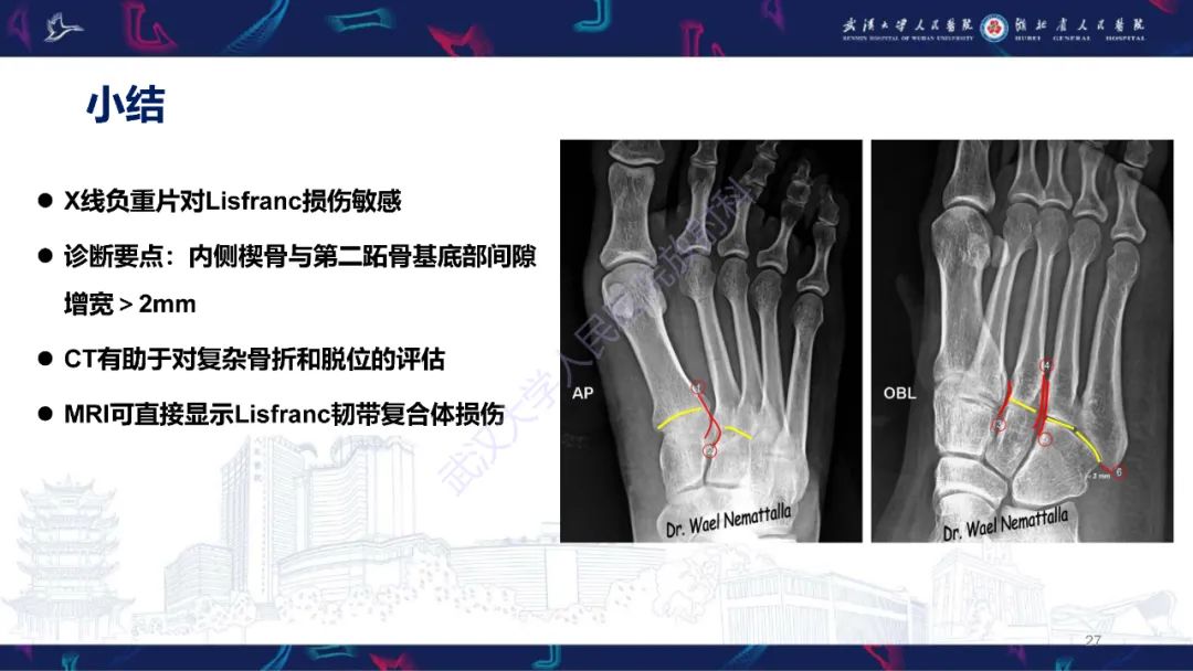 影像PPT - 【PPT】Lisfranc关节损伤影像诊断-27