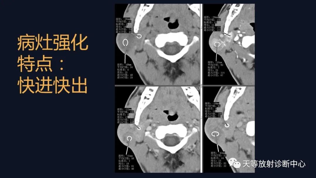 影像PPT - 【病例】腮腺Warthin瘤(腺淋巴瘤)1例CT影像-39 影像PPT - 【病例】腮腺Warthin瘤(腺淋巴瘤)1例CT影像-39