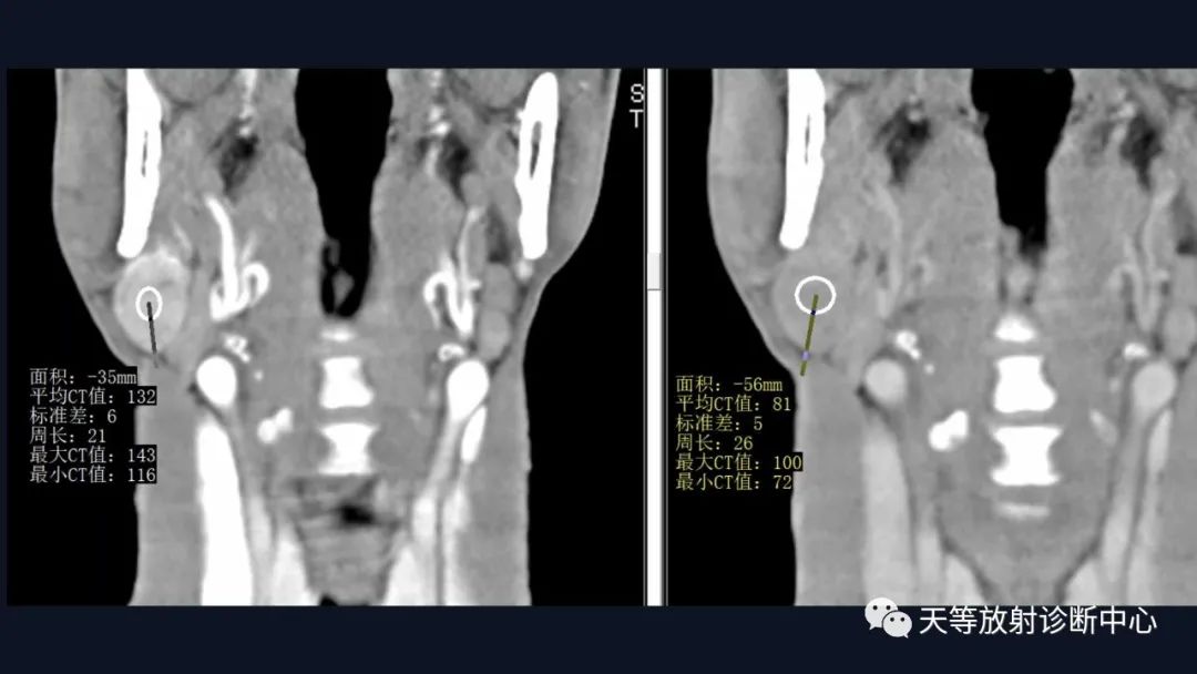 影像PPT - 【病例】腮腺Warthin瘤(腺淋巴瘤)1例CT影像-37 影像PPT - 【病例】腮腺Warthin瘤(腺淋巴瘤)1例CT影像-37