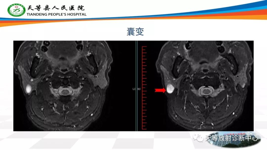 影像PPT - 【病例】腮腺Warthin瘤(腺淋巴瘤)1例CT影像-45 影像PPT - 【病例】腮腺Warthin瘤(腺淋巴瘤)1例CT影像-45