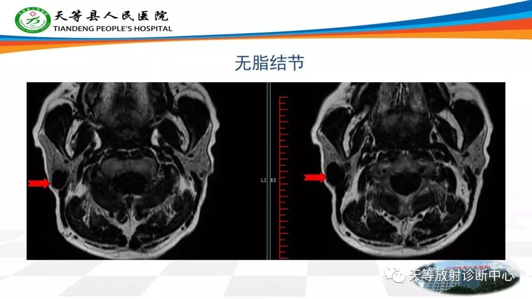 影像PPT - 【病例】腮腺Warthin瘤(腺淋巴瘤)1例CT影像-47 影像PPT - 【病例】腮腺Warthin瘤(腺淋巴瘤)1例CT影像-47